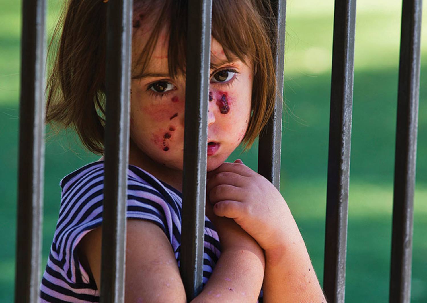Lizzy Hendrickson hangs on a fence while playing during recess at Prince of Peace Preschool in Phoenix, Ariz. The four-year-old suffers from Epidermolysis Bullosa, a rare genetic skin disease that causes the skin to be so fragile that the slightest friction can cause severe blistering. There is no cure.